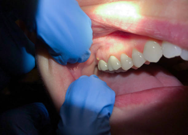 Best Emergency Treatment for Toothache in Woodlyn, PA
